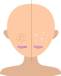 types of pigmentation